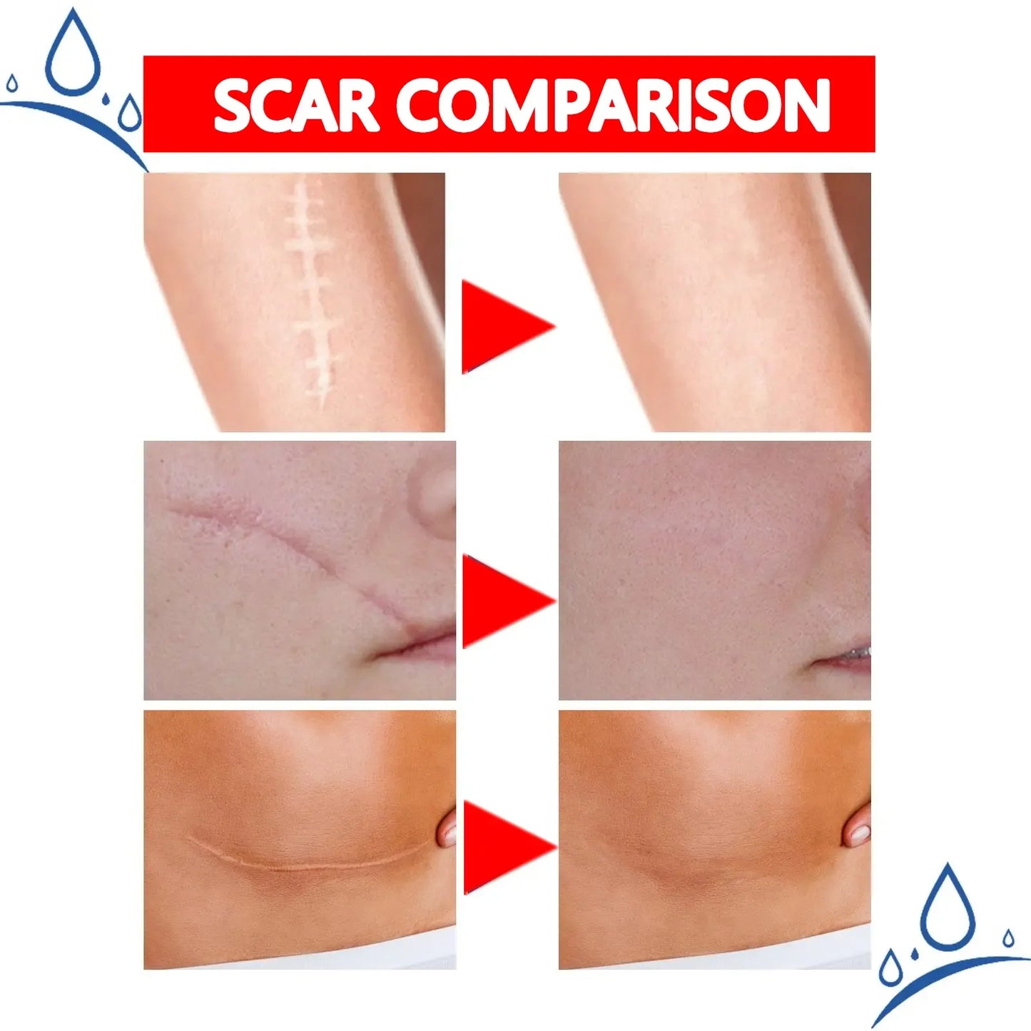 Professional and powerful scar removal gel - suitable for scar removal treatment of post-operative scars, caesarean section scars, keloids, burns, acne, etc.-A