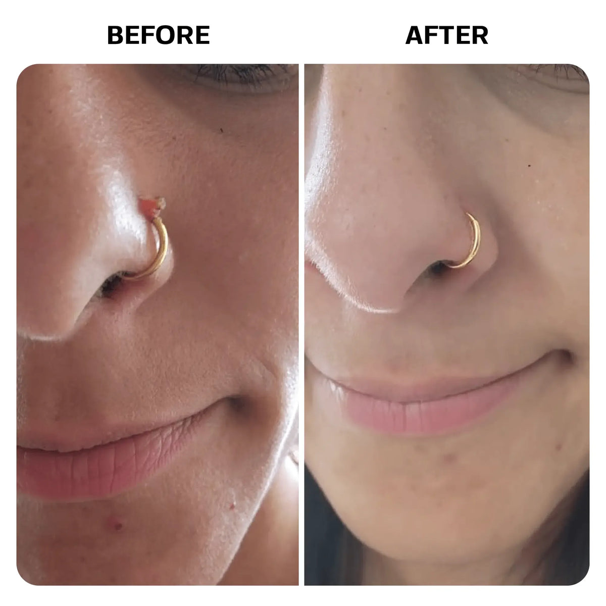 Keloid Bump Removal Gel | Natural Piercing Bump Treatment & Keloid Scar Gel | Keloid Scar Removal for all Scars, Keloids & Piercing Bumps | Soothing Piercing Aftercare | 2 oz