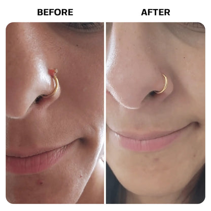 Keloid Bump Removal Gel | Natural Piercing Bump Treatment & Keloid Scar Gel | Keloid Scar Removal for all Scars, Keloids & Piercing Bumps | Soothing Piercing Aftercare | 2 oz